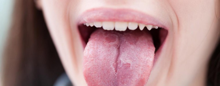 LÀM SAO ĐỂ CHỮA NHIỆT MIỆNG Ở LƯỠI?