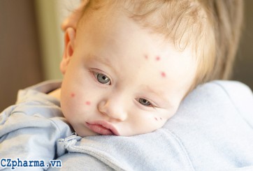 Trị muỗi đốt cho bé như thế nào là đúng cách ?