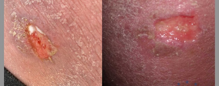 Bệnh nhân bị vết loét mạn tính ở lưng