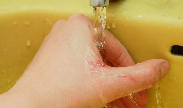 Rửa tay dưới vòi nước và sát trùng vết cắn